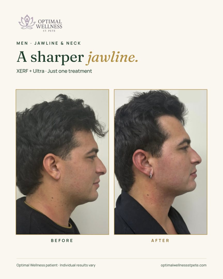 Before and after XERF with LaseMD Ultra on a male patient's jawline and neck at Optimal Wellness St. Pete. Individual results vary.